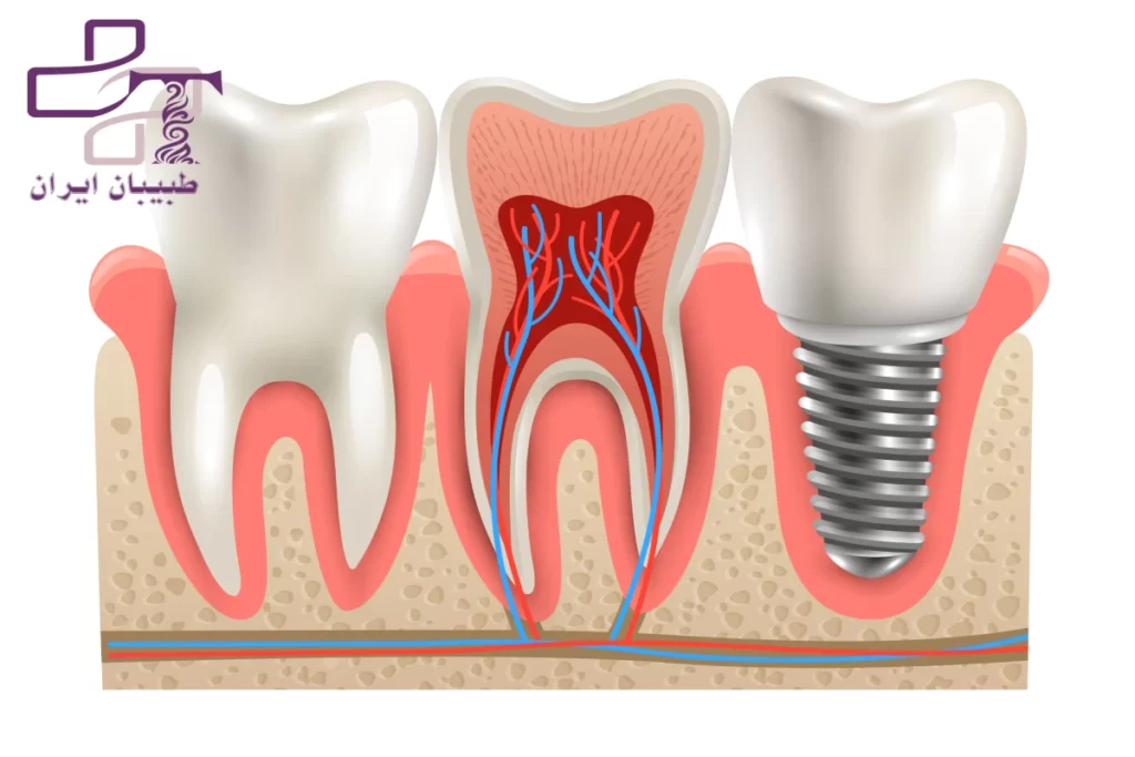 عوارض ایمپلنت دندان- سایت طبیبان ایران