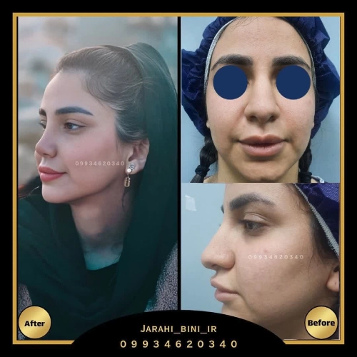 نمونه کار- دکتر اکبر اعتمادی- بهترین جراح بینی در تهران