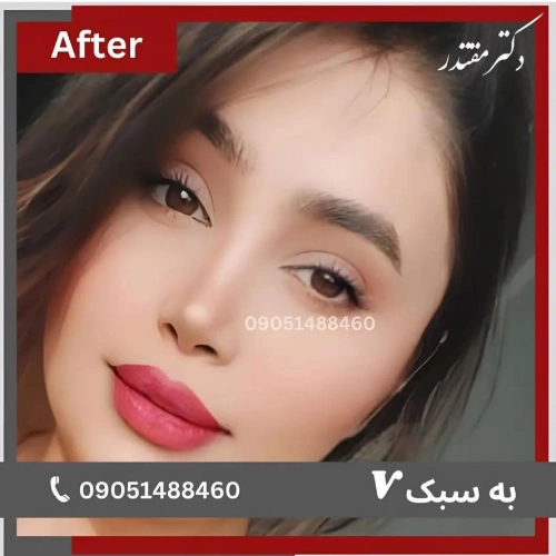 نمونه کار-دکتر مقتدر- بهترین جراح بینی در تهران