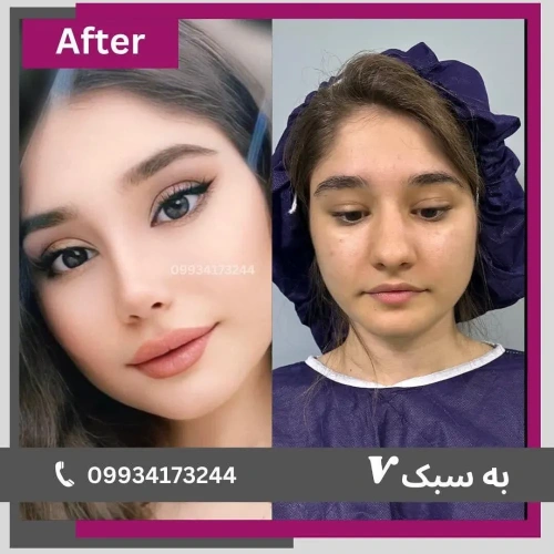 نمونه کار- دکتر آرزو خوانساری نیا- بهترین جراح بینی در تهران