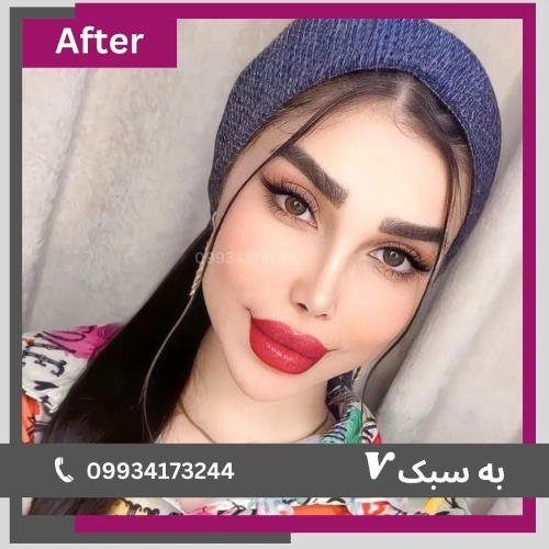 نمونه کار- دکتر آرزو خوانساری نیا- بهترین جراح بینی در تهران