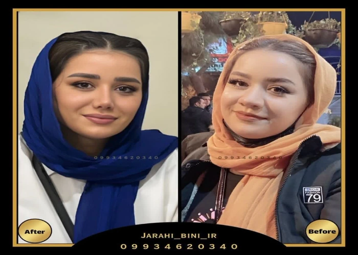 دکتر آرزو خوانساری نیا- بهترین جراح بینی استخوانی در تهران