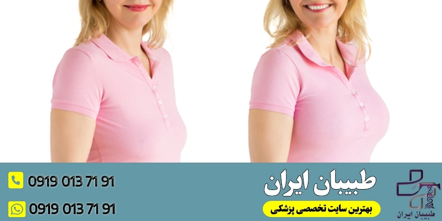 سن مناسب برای انجام پروتز سینه 