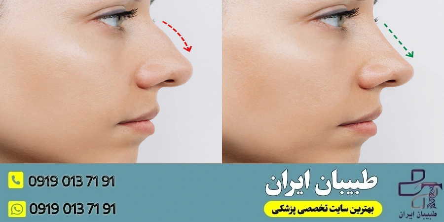 جراحی بینی استخوانی چیست؟