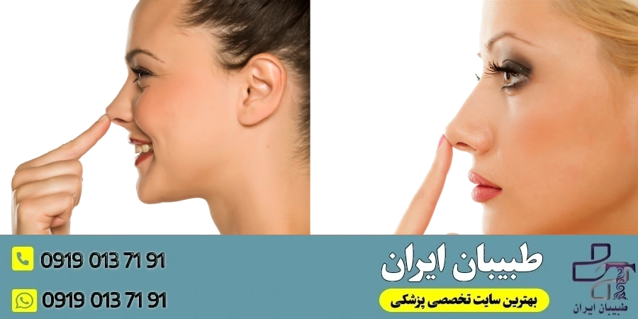 مدل_های جراحی بینی استخوانی