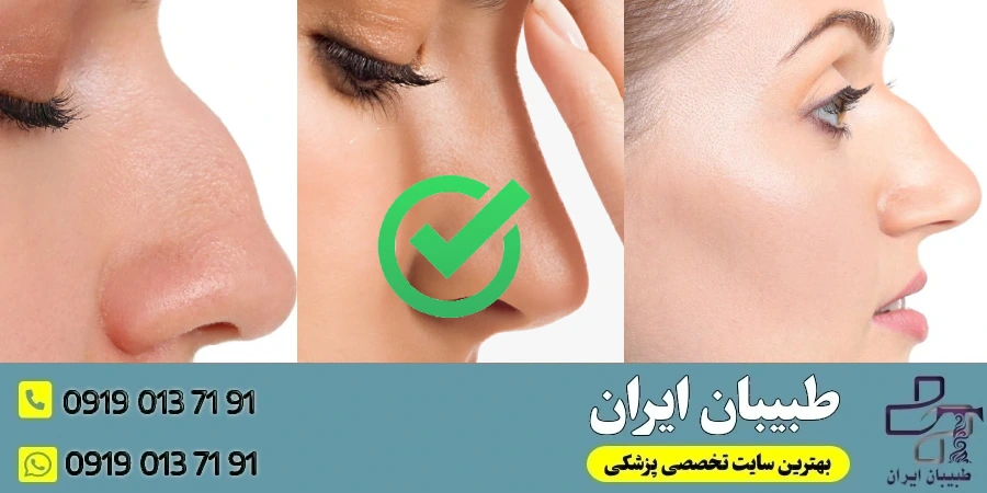 ویژگی_های بینی استخوانی