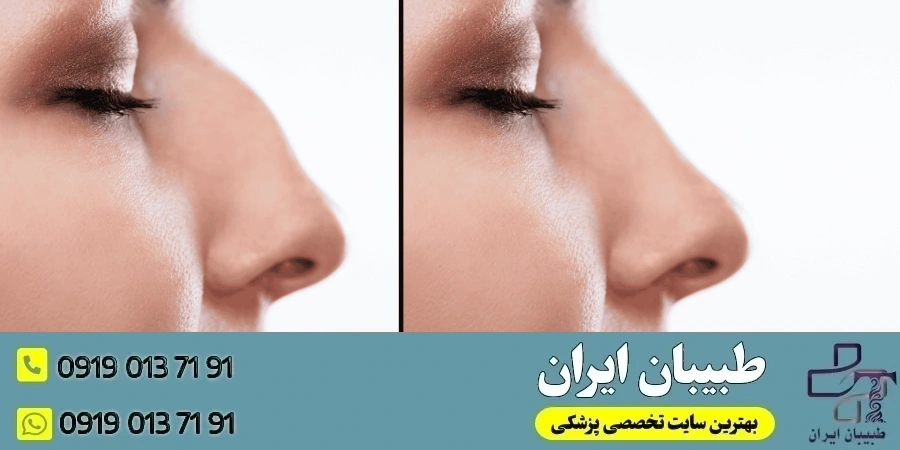 جراحی بینی- خطرات جراحی بینی