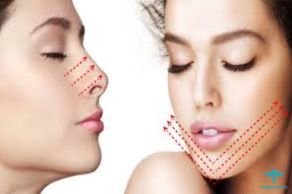 اصلاح فرم بینی با آر اف