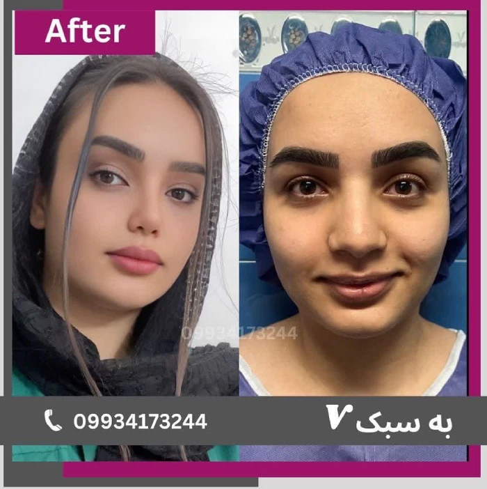 نمونه جراحی بینی دکتر آرزو خوانساری‌نیا