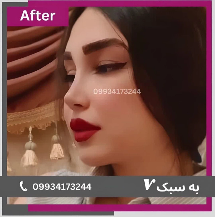 نمونه جراحی بینی دکتر آرزو خوانساری‌نیا