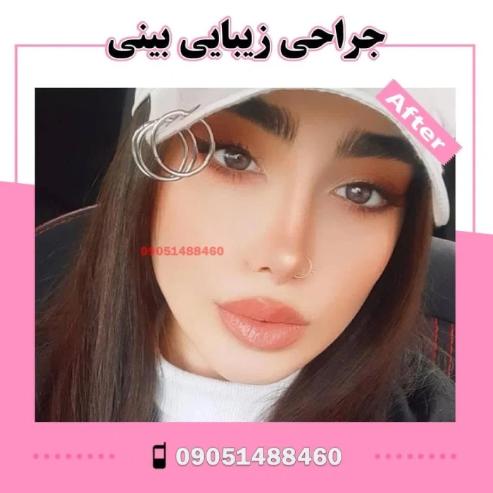 نمونه جراحی بینی دکتر آرزو خوانساری‌نیا