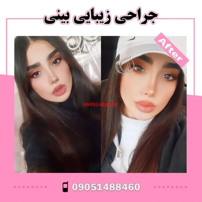 نمونه جراحی بینی دکتر آرزو خوانساری‌نیا