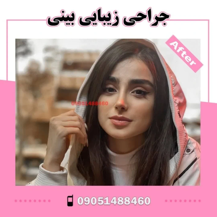 نمونه جراحی بینی دکتر آرزو خوانساری‌نیا