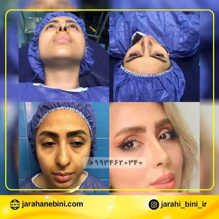 نمونه جراحی بینی گوشتی دکتر اعتمادی