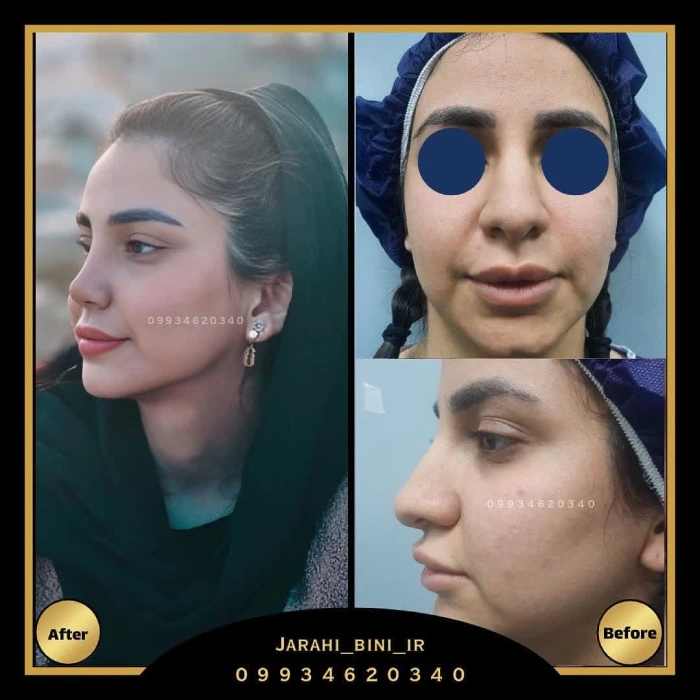 نمونه جراحی بینی گوشتی دکتر اعتمادی
