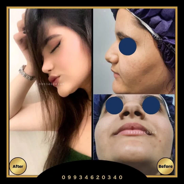 نمونه جراحی بینی گوشتی دکتر اعتمادی