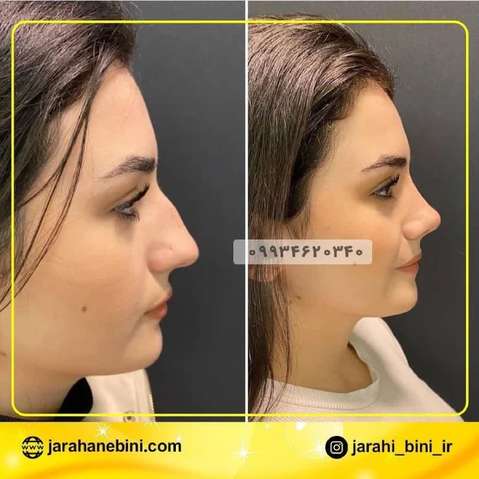 نمونه جراحی بینی گوشتی دکتر اعتمادی