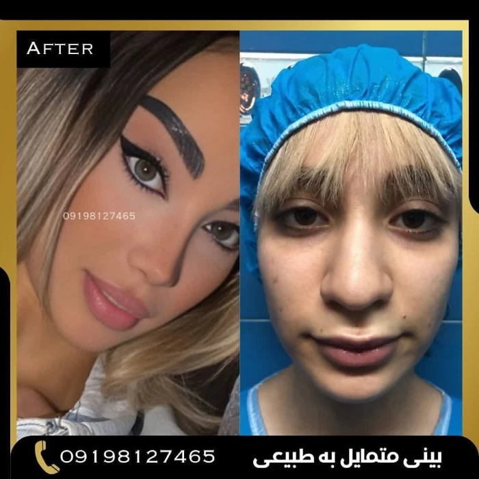 نمونه جراحی بینی دکتر پوریوسف