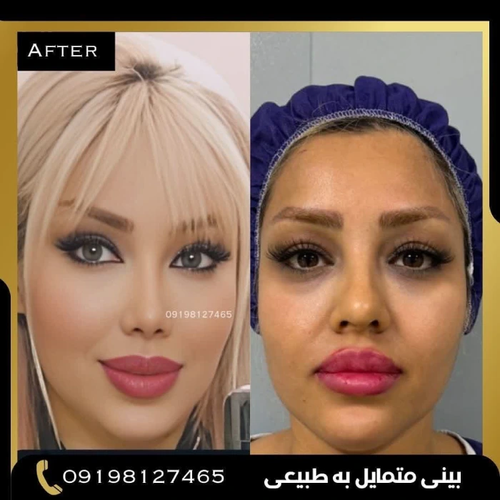نمونه جراحی بینی دکتر پوریوسف