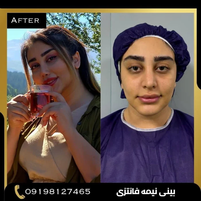 نمونه جراحی بینی دکتر پوریوسف