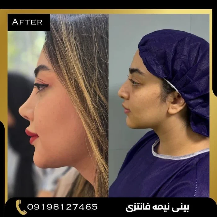 نمونه جراحی بینی دکتر پوریوسف