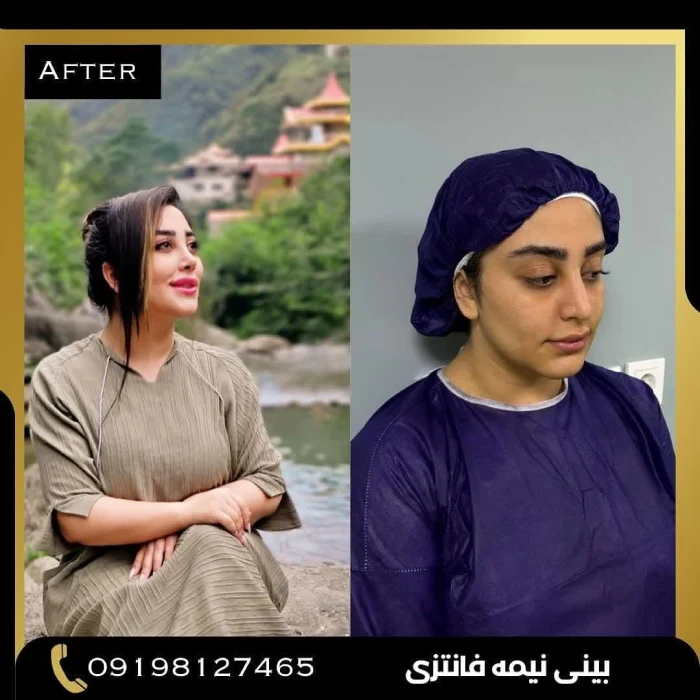 نمونه جراحی بینی دکتر پوریوسف