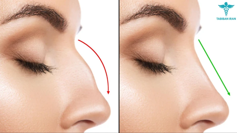 محبوبیت جراحی بینی طبیعی