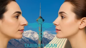 بهترین جراح بینی استخوانی در تهران- طبیبان ایران
