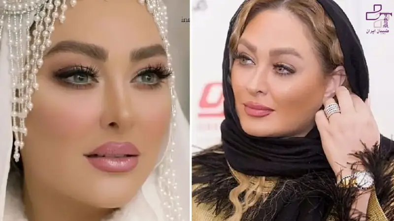 تکنیکهای جراحی بینی بازیگران و بلاگرها