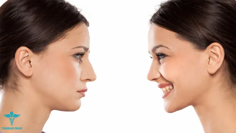 اشتباهات رایج در تحلیل قبل و بعد از عمل بینی