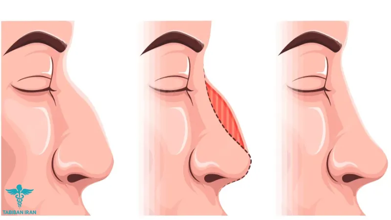 تصاویر قبل و بعد از عمل بینی