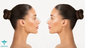 قبل و بعد از عمل بینی- طبیبان ایران