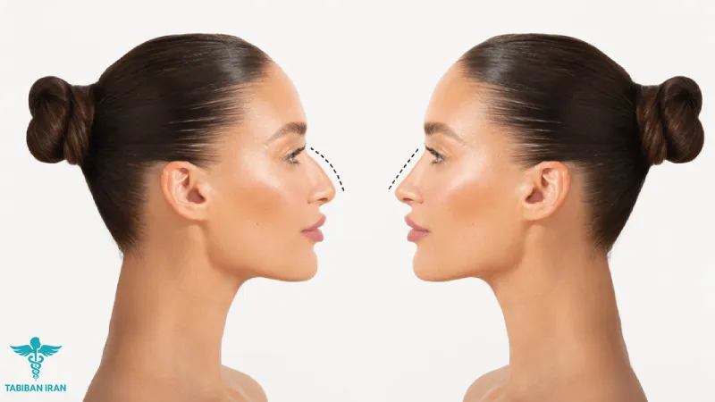 قبل و بعد از عمل بینی- طبیبان ایران