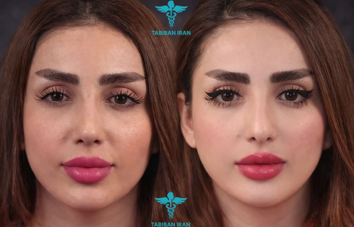 ترند ۱: بازگشت قدرتمند بینی طبیعی (Natural Nose)