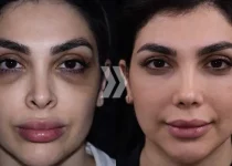 جراحی بینی بعد از ۳۰ سالگی- طبیبان ایران