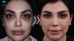 جراحی بینی بعد از ۳۰ سالگی- طبیبان ایران