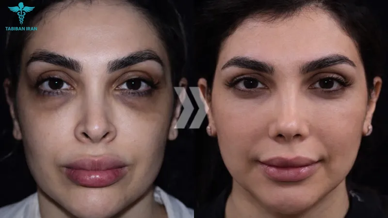 جراحی بینی بعد از ۳۰ سالگی- طبیبان ایران