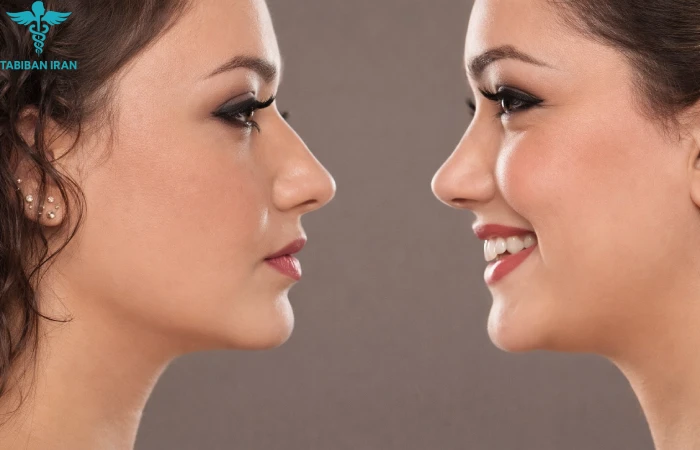 ۱۰ ترند برتر جراحی بینی 2026 | مدل طبیعی و پایان بینی فانتزی|طبیبان ایران