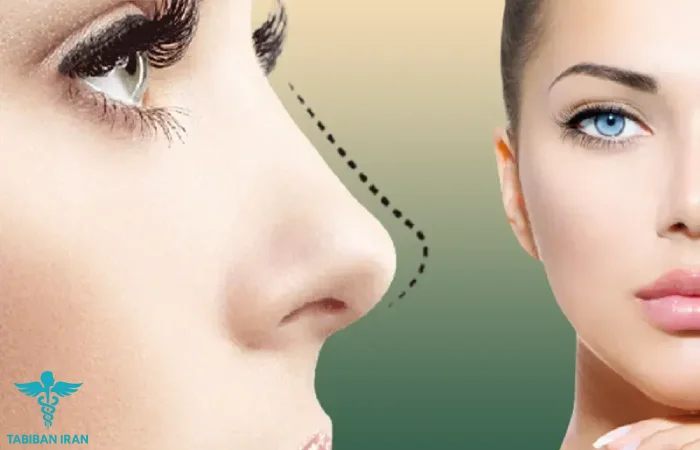 عوامل تاثیر گذار بر هزینه عمل بینی